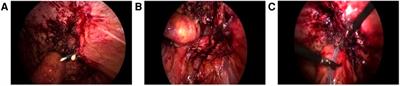 Surgical treatment strategy for recurrent parastomal hernia: Experiences from 17 cases